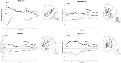 Fluid mechanics of aortic valve incompetence in the dilated left ventricle